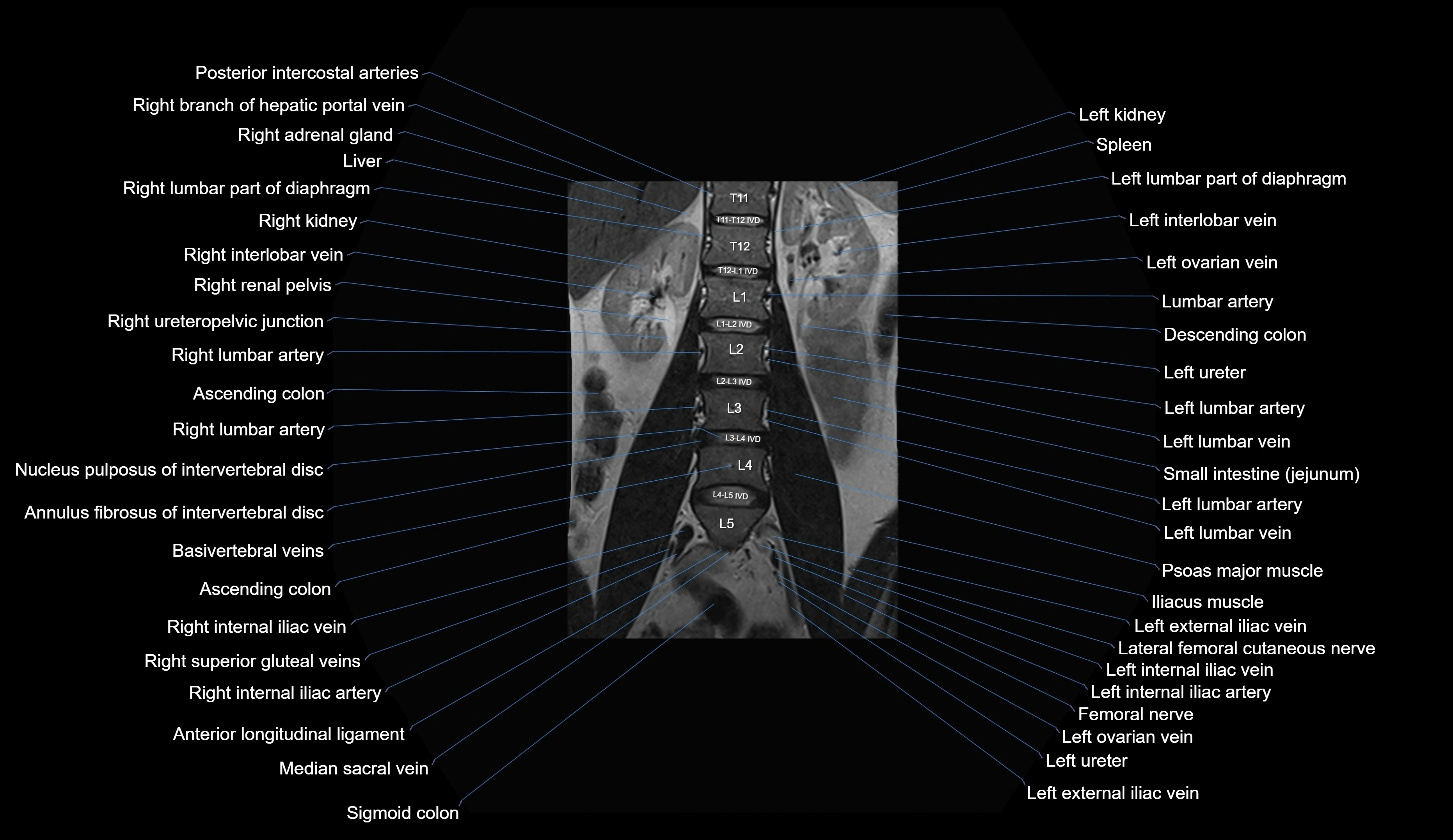 MRI lumbar spine coronal cross sectional anatomy 3T radiology  image-img-00001-00013.webp